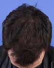 After Hair Transplant&nbsp;Front